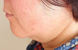 Facial Cosmetic Acupuncture. M before chin