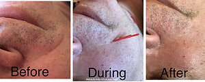 Facial Cosmetic Acupuncture. beforeafter1