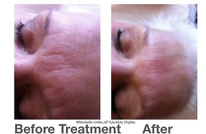 Facial Cosmetic Acupuncture. before after6
