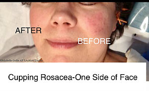 Facial Cosmetic Acupuncture. before after rosacea