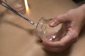 About Acupuncture. firecupping