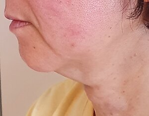 Facial Cosmetic Acupuncture. M after chin