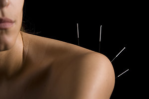 About Acupuncture. shoulderpic